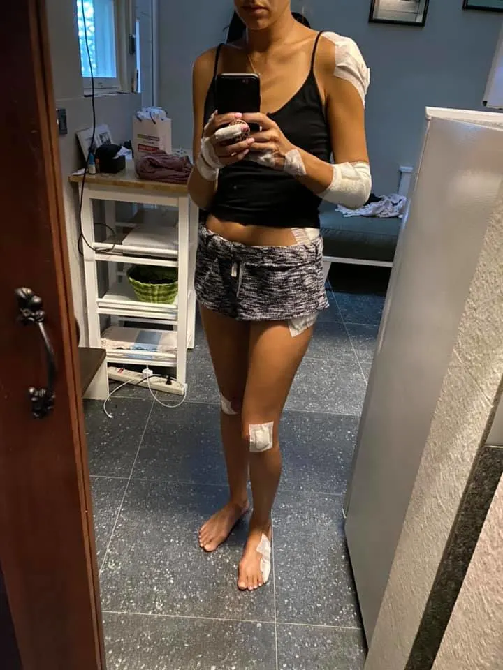 stacey serrano injured in bali