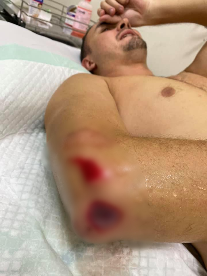 boyfriend injured robbery bali
