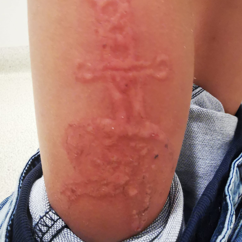 MDlink  This lady was left with intense chemical burns  Facebook