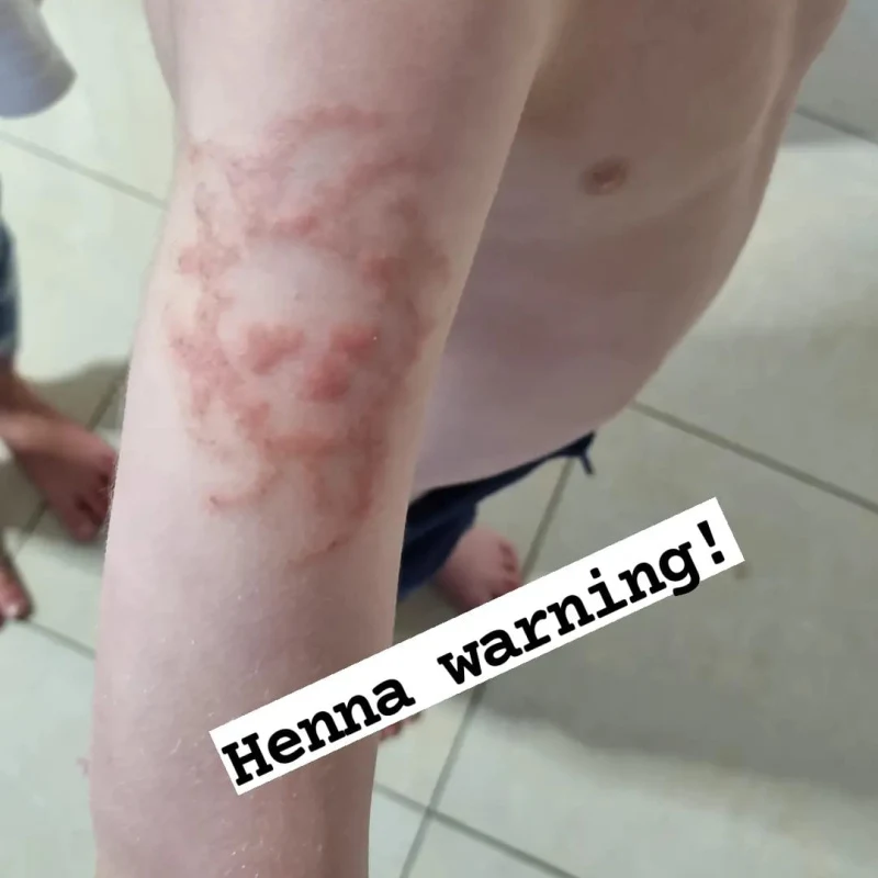 Dangerous black henna tattoos leaving Bali tourists with permanent scars